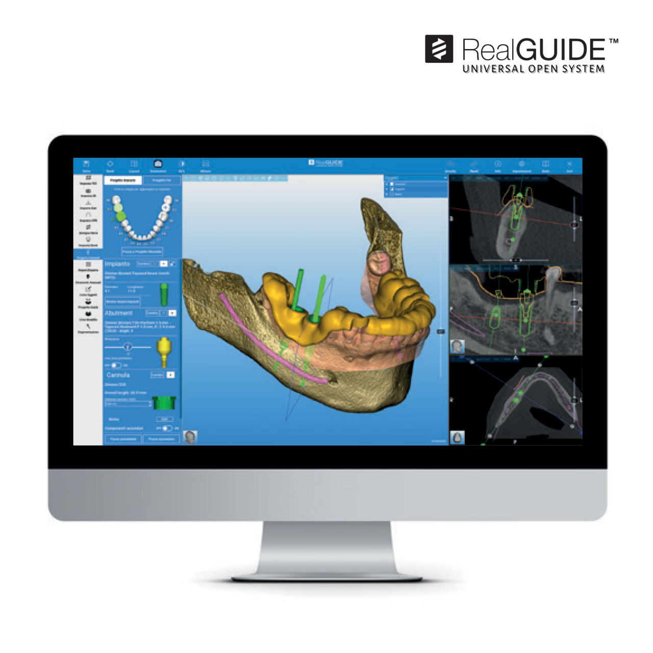 Computer Monitor Displaying ZimVie Dental Guided Implant Surgery Encode RealGuide Software